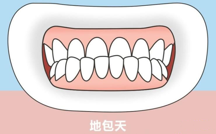 如果孩子有“地包天”，該怎么辦？